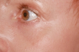 Laser resurfacing after operation Laser resurfacing after operation