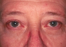 Lower Blepharoplasty After Operation Lower Blepharoplasty After Operation