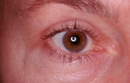 Upper Blepharoplasty After Operation Upper Blepharoplasty After Operation